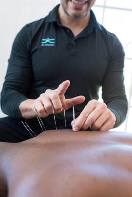 Dry Needling Acupuncture