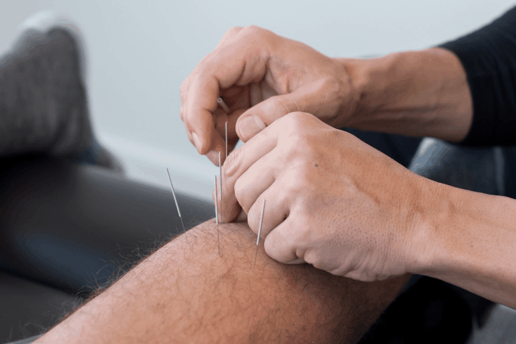 Acupuncture Indianapolis Indiana